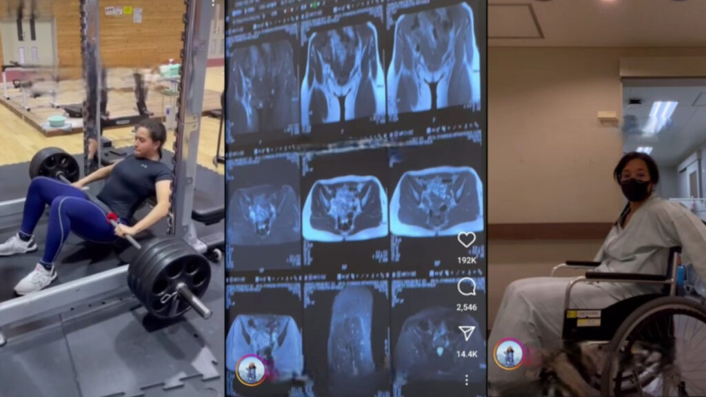 California Woman Snaps Hip in Half Following Viral Gym Trend: ‘A Pain So Excruciating I Can’t Even Put It Into Words’ A collage of a woman lifting weights, X-rays showing her broken hip, and her sitting in a wheelchair while she recovers from injuries sustained from a viral gym trend