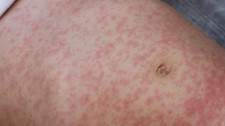 LA Sees Its First Measles Case As Disease Rises Around the U.S.: ‘I hate this timeline’ A stomach covered in red bumps resulting from measels as found in LA