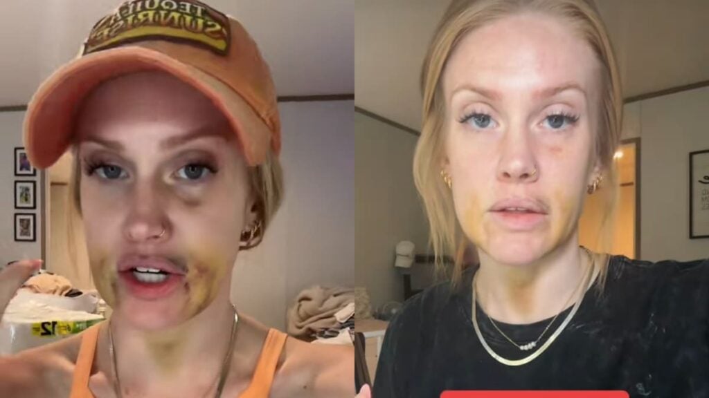 South Carolina Woman Left Black and Blue After Wisdom Teeth Surgery: ‘Were You Fighting the Dentist?!’ A picture of the South Carolina woman.