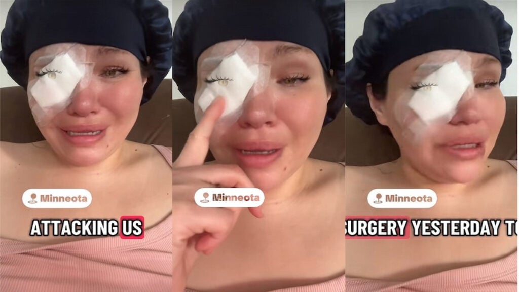 Another Traumatic ICE Encounter in Minnesota: Indigenous Person Speaks Out, ‘I Don’t Know If I’m Gonna Be Blind in This Eye or Not’ Screenshots of Edith's video showing her bandaged eye injury after being brutalized by ICE agents in Minnesota