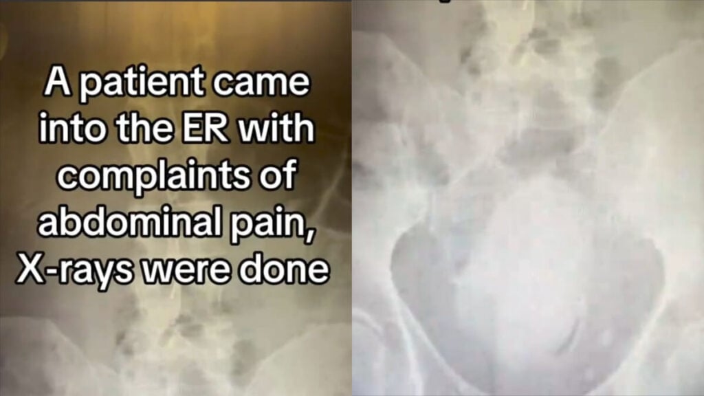 X Ray Shows Mango Stuck Inside Arizona Man