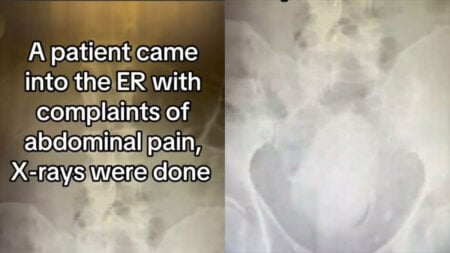 X Ray Shows Mango Stuck Inside Arizona Man