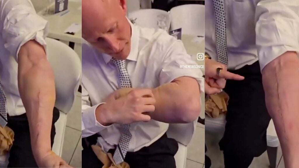 North Carolina Senate Candidate Brian McGinnis Shows Surgical Scars After Being Forcibly Removed from Senate Hearing Brian McGinnis, North Carolina Marine veteran and Green Party Senate candidate, showing surgical scars and metal hardware on his left forearm following surgery for a broken arm sustained during his removal from a Senate hearing.