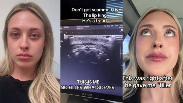 California Med Spa Lip Filler Scam Claims