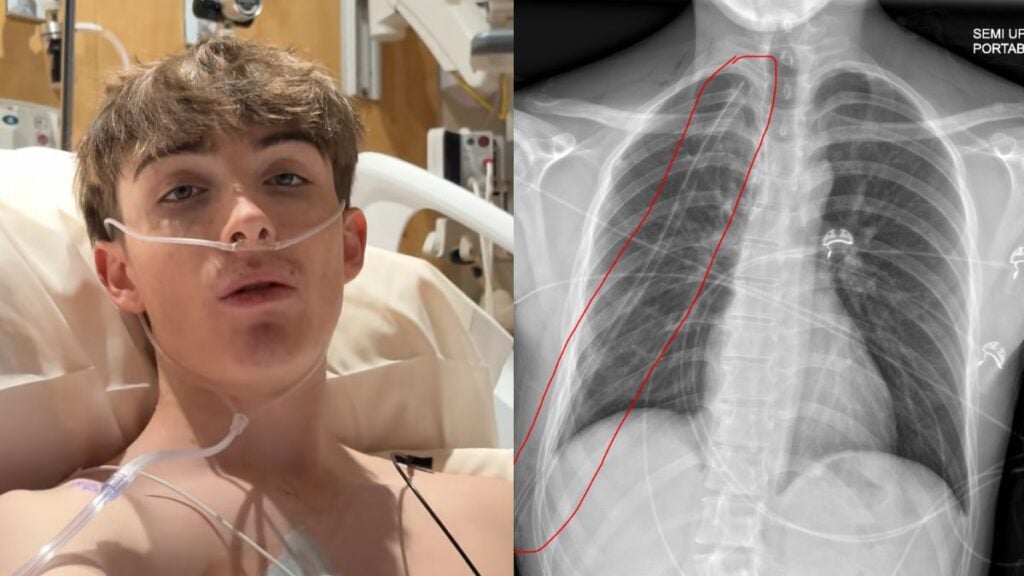 Arizona Man Records Emotional Video After Fifth Collapsed Lung Surgery: ‘I’m in the Lowest Point in My Life’ Arizona Man Records Emotional Video After Fifth Collapsed Lung Surgery