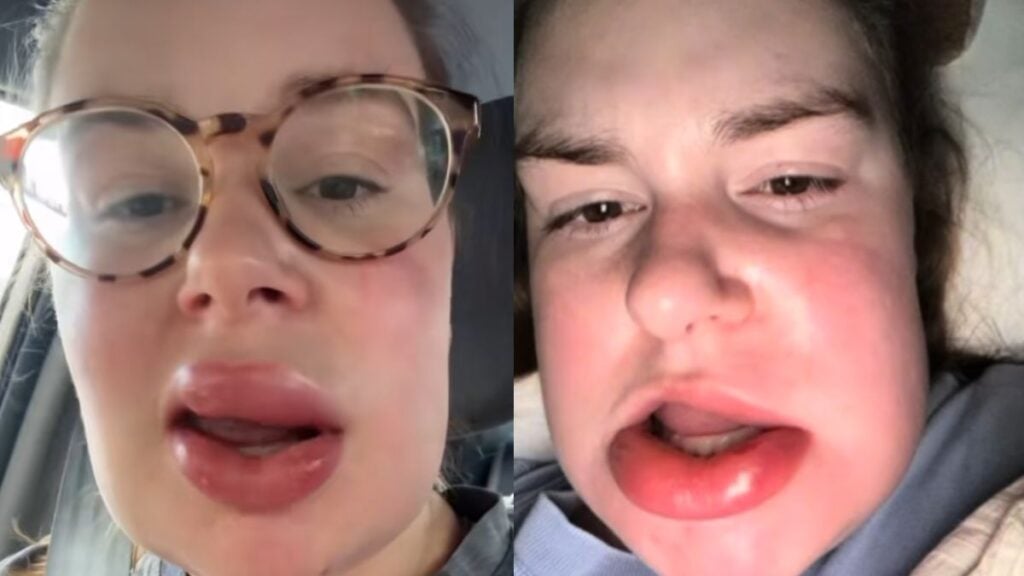 Illinois Woman Claimed Chewing on Her Lip While Sleeping Sent Her to ER: ‘Do You Have Bees for Teeth by Any Chance?’ Illinois Woman Chewed on Her Lip While Sleeping, Ends up at ER
