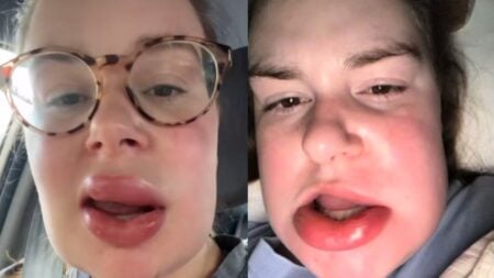 Illinois Woman Claimed Chewing on Her Lip While Sleeping Sent Her to ER: ‘Do You Have Bees for Teeth by Any Chance?’ Illinois Woman Chewed on Her Lip While Sleeping, Ends up at ER