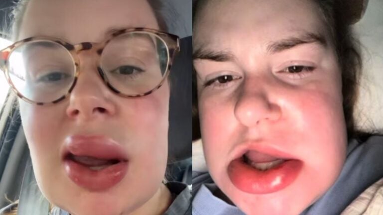 Illinois Woman Claimed Chewing on Her Lip While Sleeping Sent Her to ER: ‘Do You Have Bees for Teeth by Any Chance?’ Illinois Woman Chewed on Her Lip While Sleeping, Ends up at ER