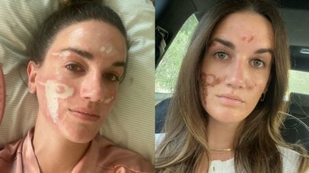 California Celebrity Esthetician Loses License Years After Client Was Left Permanently Scarred