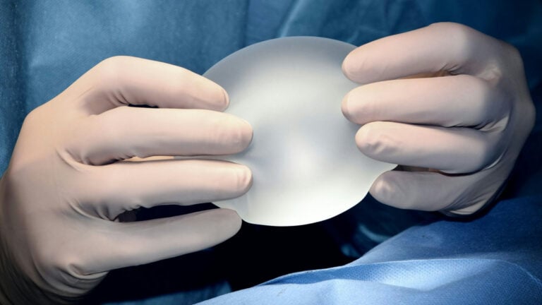 ‘My Breasts Exploded’: Washington Woman Says Her Breast Implants ‘Self-Combusted’ 25 Years After Double Mastectomy Plastic surgeon holding a breast implant
