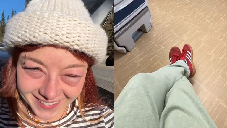 Washington Woman’s Trail Hike Takes a Turn After Severe Eye Allergic Reaction Sends Her To Urgent Care: ‘I Don’t Have Health Insurance’ Washington Woman’s Trail Hike Takes a Turn After Severe Eye Allergic Reaction Sends Her To Urgent Care