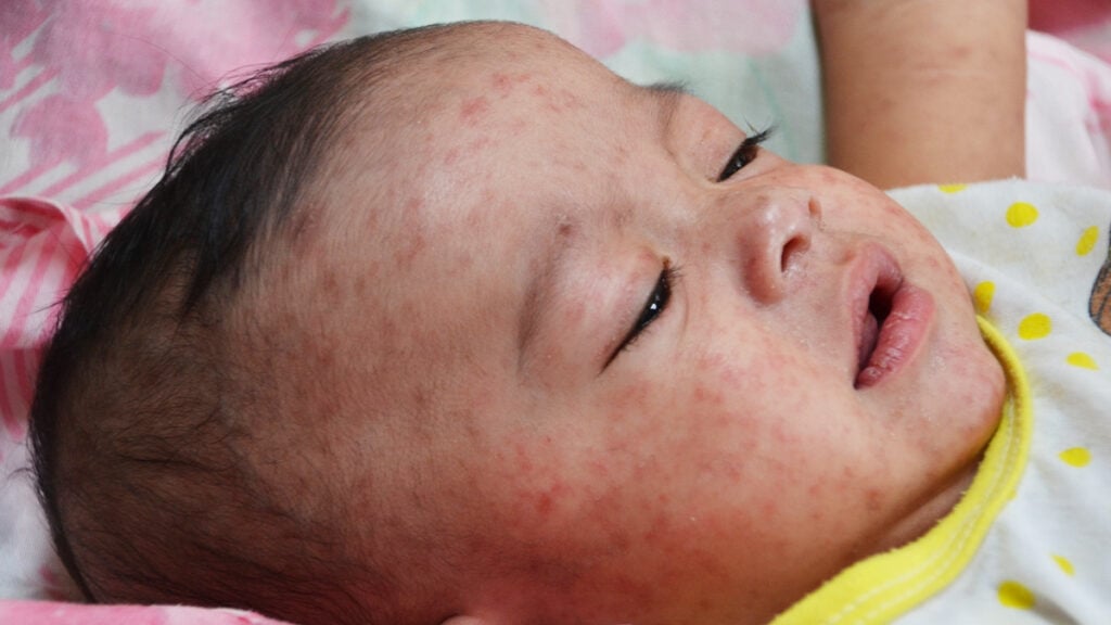 ‘MAGA Needs to Be Destroyed, They Are Killing Our Babies’: Pennsylvania Residents Blast Republicans as Deadly Measles Cases Soar to 1,286 pennsylvania babies measles MAGA republican