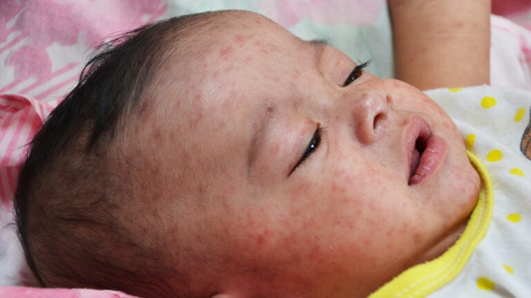 pennsylvania babies measles MAGA republican
